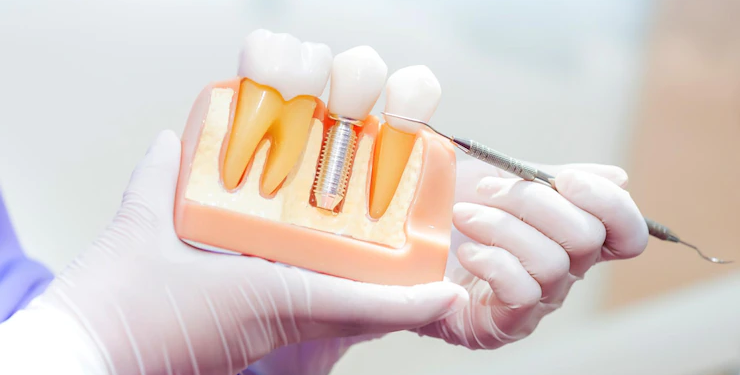 cost of dental implants panama city beach fl