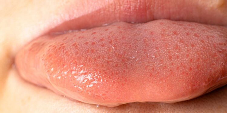 What Is Candida and Thrush: Everything You Need to Know