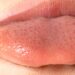 What Is Candida and Thrush: Everything You Need to Know