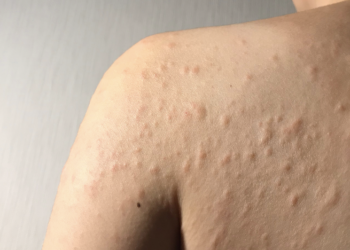 How Organic Hemp Seed Protein Can Prevent or Treat Allergies, Asthma, and Eczema